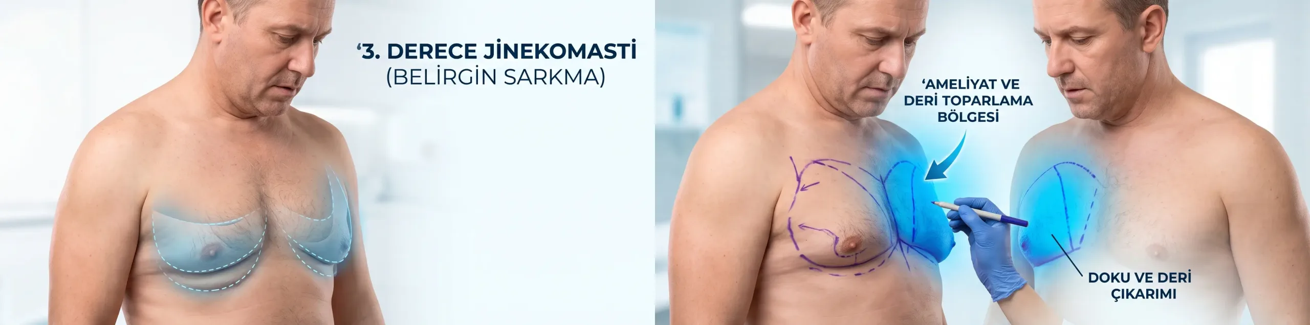3. Derece Jinekomasti