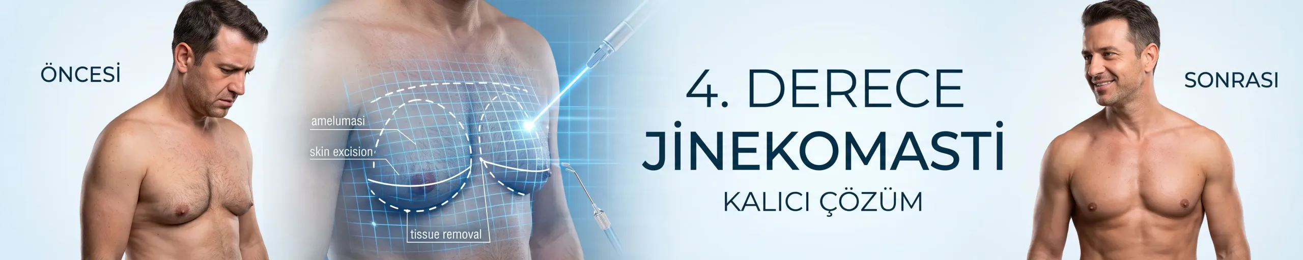 4. Derece Jinekomasti