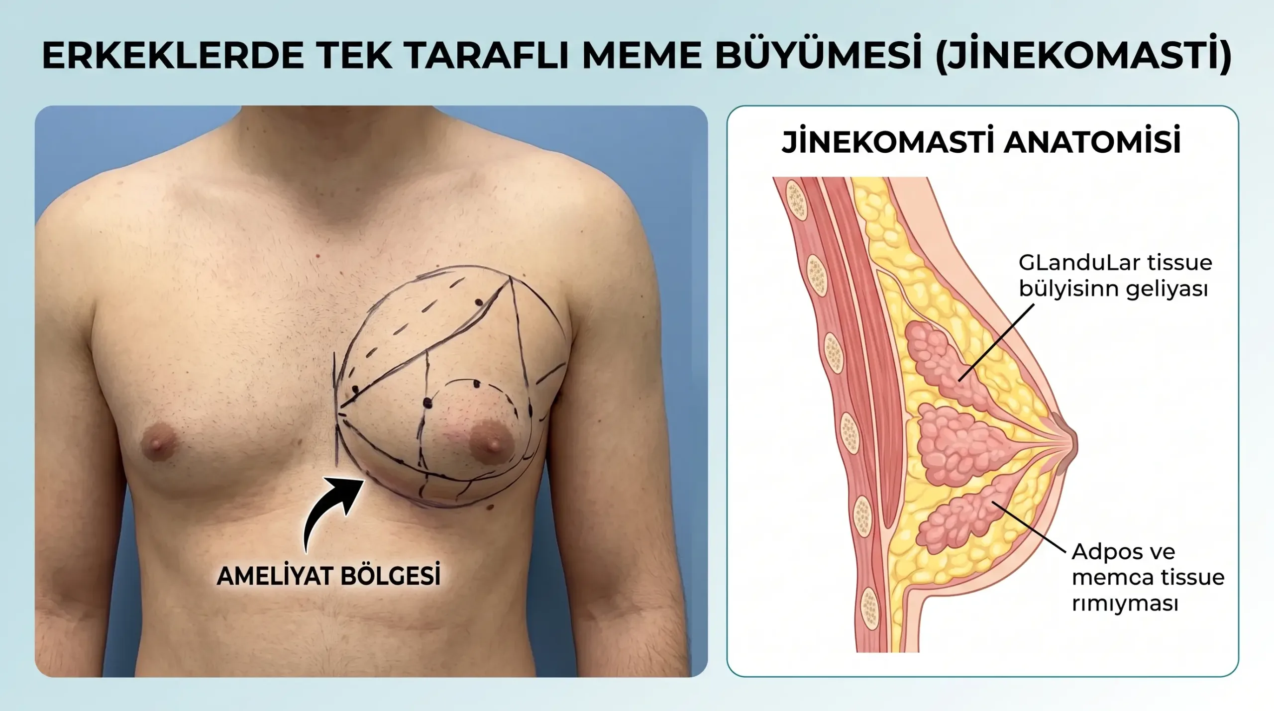 Erkeklerde Tek Taraflı Meme Büyümesi