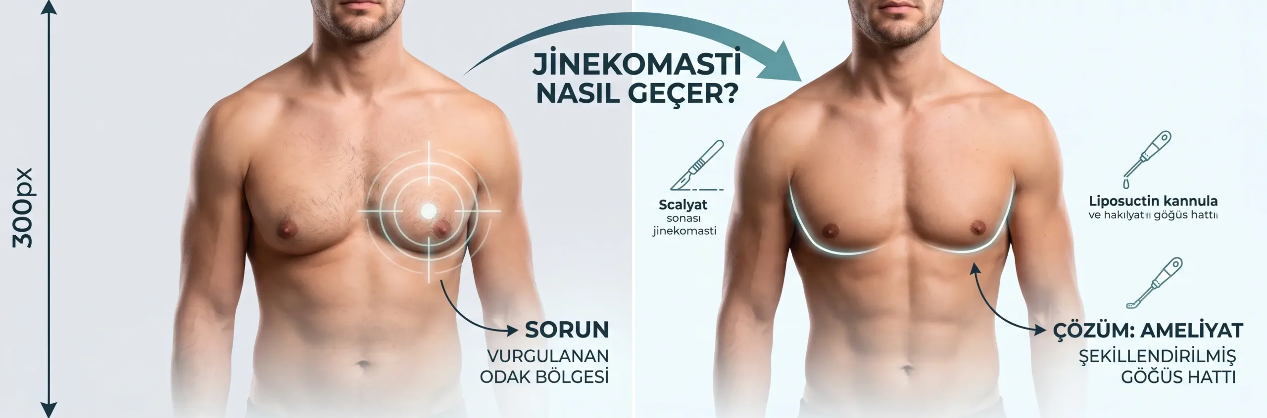 Jinekomasti Nasıl Geçer